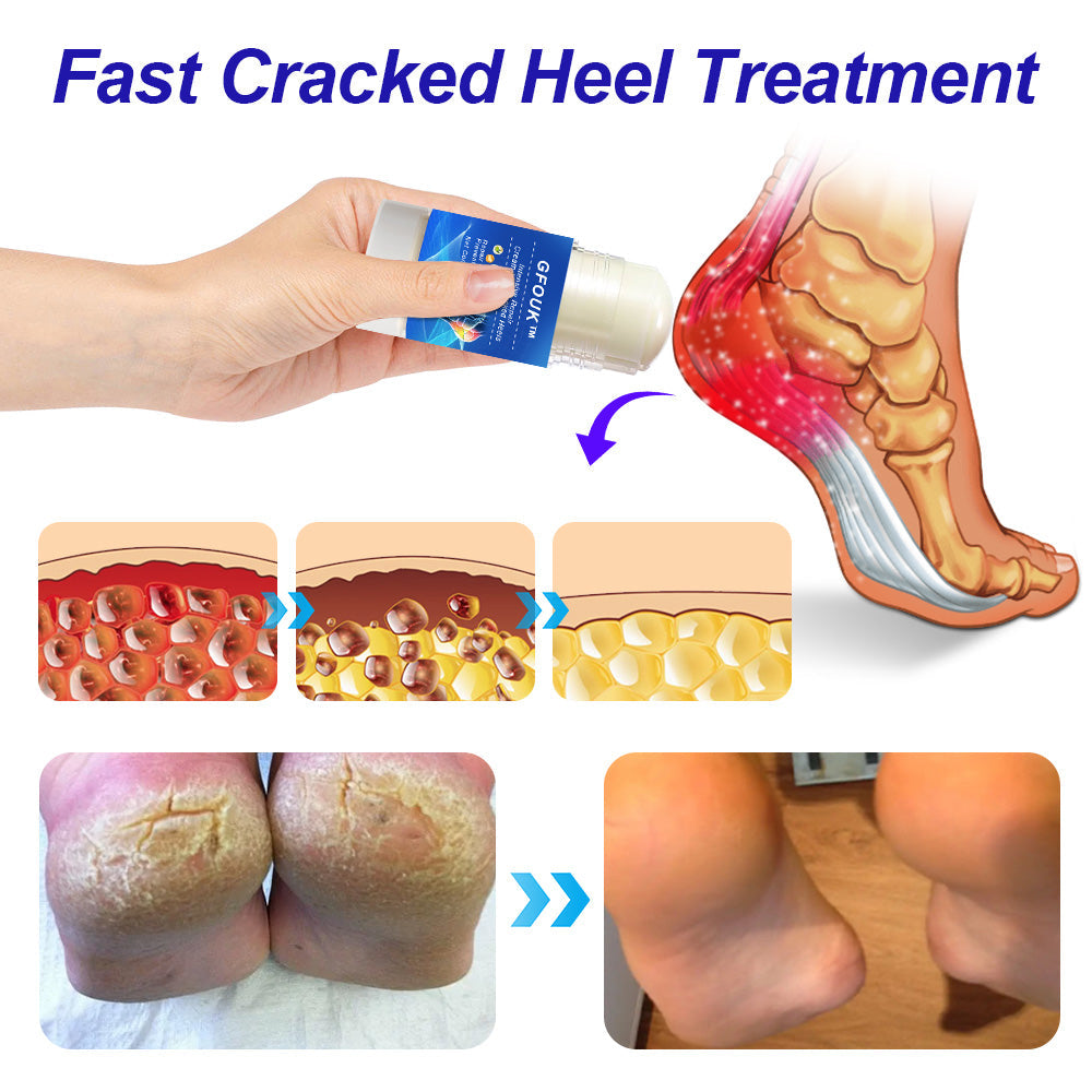 GFOUK™ Intensive Repair Cream For Cracked Heels