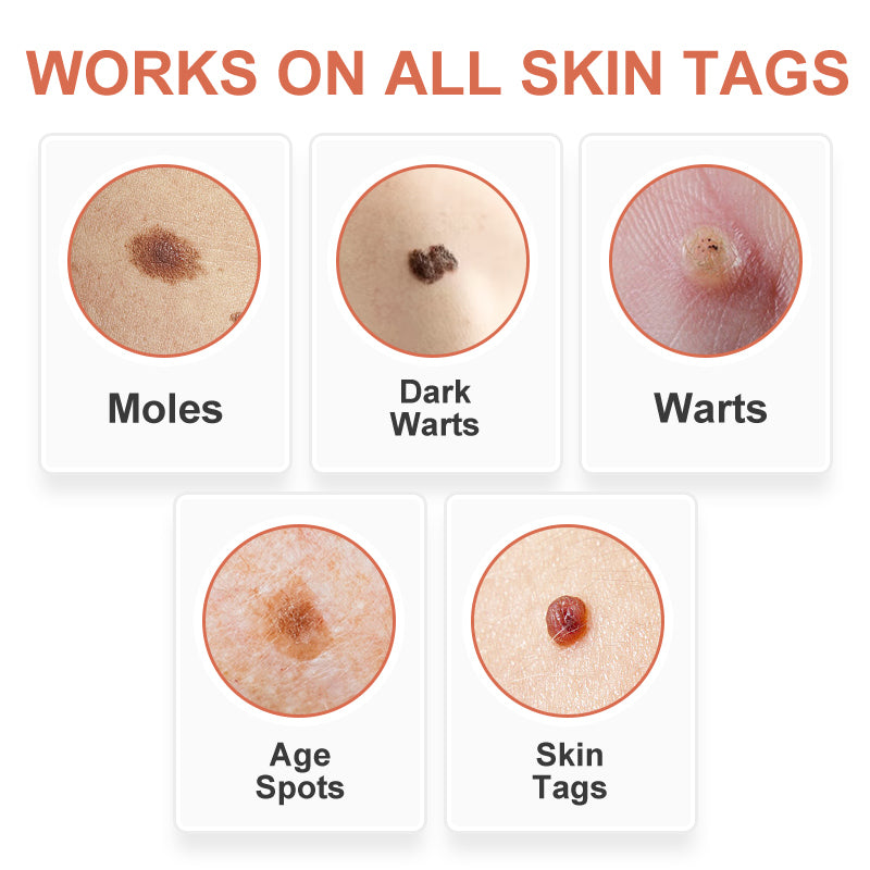 GFOUK™ WipeOff Tags And Moles Eliminator