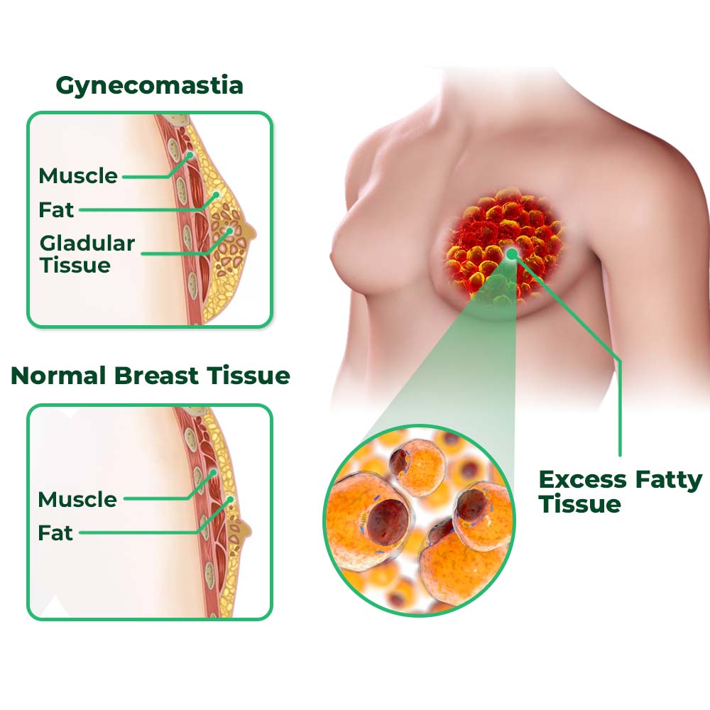 GFOUK™ GynoReduct Gynecomastia Diminishing Patch