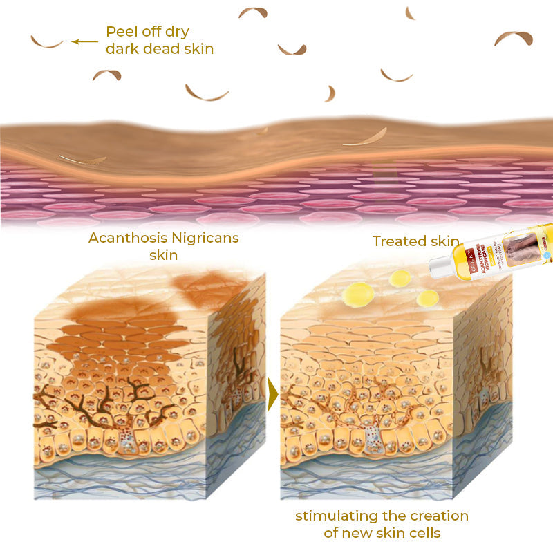 GFOUK™ Acanthosis Nigricans Peeling Oil